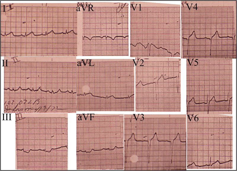 12-lead ECG from President Johnson